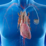 Complete Heart Block: What It Means and How It’s Treated