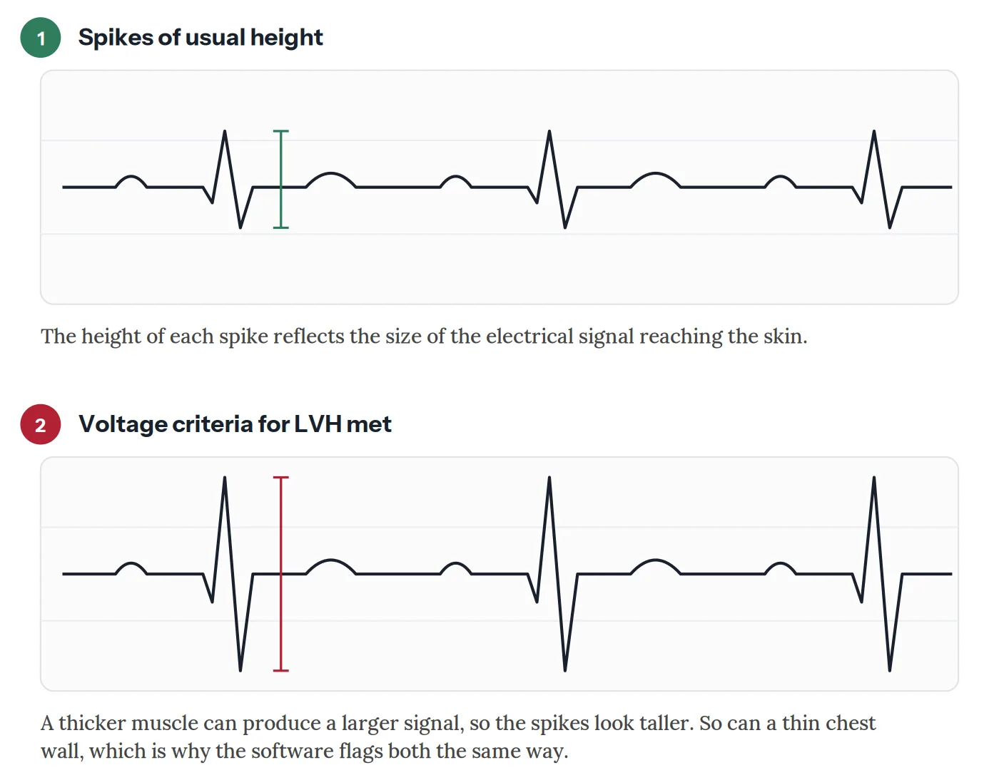 Left Ventricular Hypertrophy (LVH) on Your ECG 2 Two ECG tracings compared. In the first the spikes are of usual height. In the second they are markedly taller, which is what an automated report means by voltage criteria for left ventricular hypertrophy