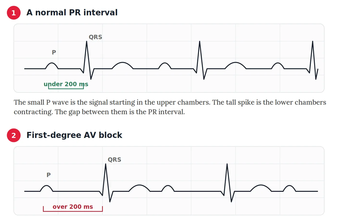 First-Degree AV Block on Your ECG: What Does It Really Mean? 2 Two ECG tracings compared. In the normal tracing the PR interval is under 200 milliseconds. In first-degree AV block the interval is longer, but every P wave is still followed by a QRS complex