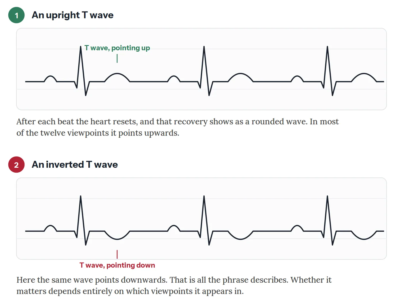 Two ECG tracings compared. In the first the T wave after each beat points upwards, which is the usual pattern in most leads. In the second the T wave points downwards, which is what a report means by T wave inversion