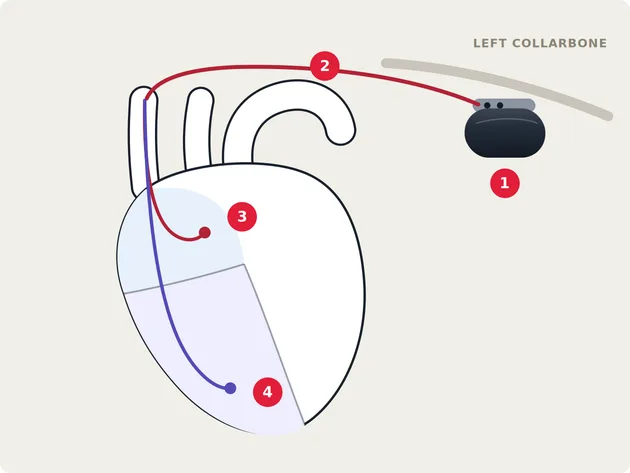 Diagram of a dual-chamber pacemaker on the left side of the chest. The pulse generator sits below the left collarbone and two leads run through a vein into the upper and lower chambers of the heart.